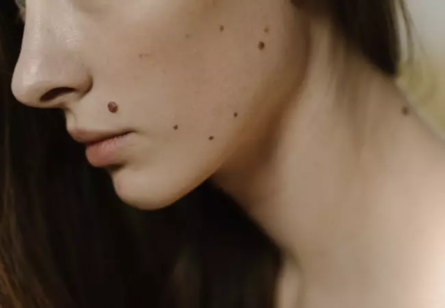 Mole and Warts on Face